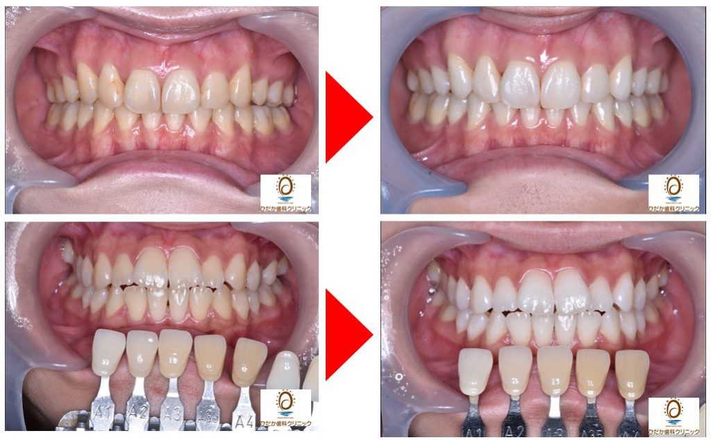 ホワイトニングの前後